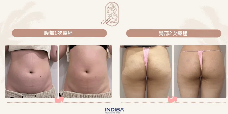 N SPA的英特波課程,可以加速體內修復,恢復緊緻的身形 台中N SPA英特波課程案例-台中體雕推薦N SPA