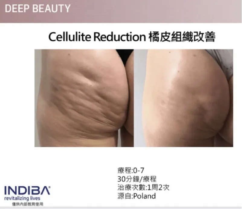INDIBA原廠屁股案例分享 INDIBA英特波原廠案例-台中無痛電波推薦N SPA