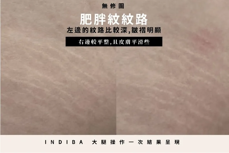 紋路的位置變得平整許多,再多做幾次效果一定會更好 INDIBA英特波肥胖紋前後差異-台中無痛電波推薦